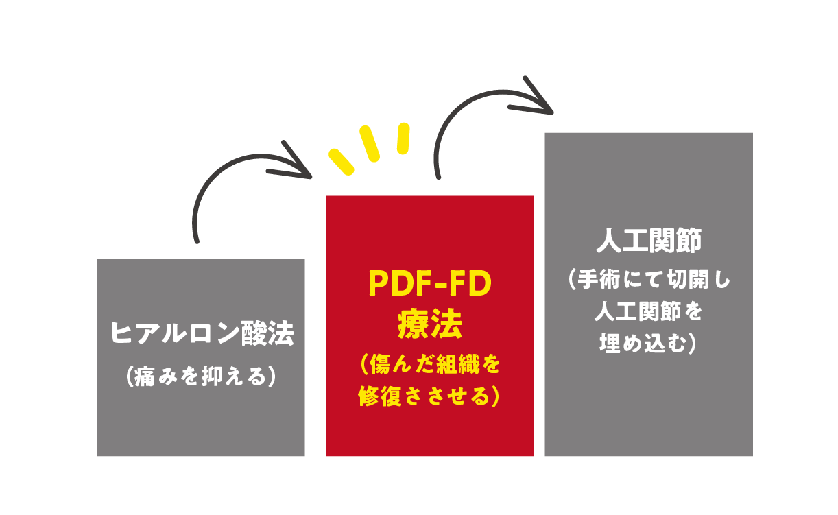 ヒアルロン酸療法・PDF-FD療法・人工関節の比較イメージ図